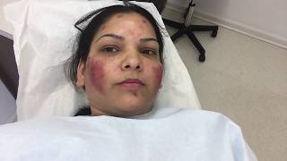 Micro needling Acne scar treatment Last Sitting Vlog Day 2 [upl. by Hermosa]