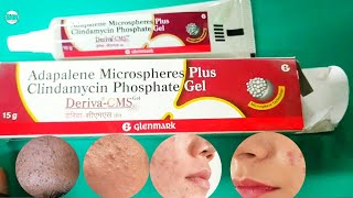 Deriva cms gel review  adapalene gel for Blackheads whiteheads acne  pimplesdarkspots पिंपल [upl. by Anelam354]