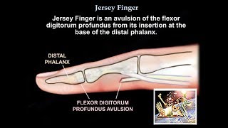 Jersey Finger  Everything You Need To Know  Dr Nabil Ebraheim [upl. by Akinwahs]