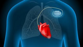 Placement of a pacemaker on the patients ♥ [upl. by Idel823]