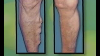 Varicose Vein Treatment by Laser  Endovenous Saphenous Vein Ablation  ELVES [upl. by Macdonell]