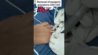 Removal of pyogenic granuloma with CO2 laser [upl. by Kloman940]