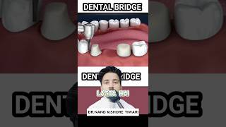 Dental BRIDGE procedure  Dental BRIDGE kaise BANTA HAI ❓shorts dental [upl. by Tri]