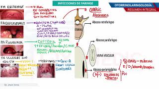 Otorrinolaringología  Infecciones de faringe [upl. by Sirret45]