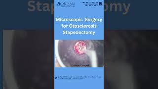 👂🔍 Dive into the World of Microscopic Surgery for Otosclerosis Stapedectomy at Dr Ram ENT Hospital [upl. by Ffirahs]