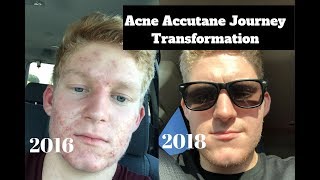 My 8 Month Accutane Transformation [upl. by Ledda]