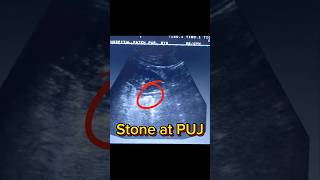 Renal Stone causing Hydronephrosis  How to diagnose Kidney Stone on Ultrasound ultrasound shorts [upl. by Belanger]