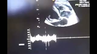 Cardiac tamponade echocardiography [upl. by Euqinu]