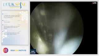 Watch Live Back Treatment Deuk Laser Disc Repair  Lumbar  Left LT L4L5 L5S1 [upl. by Stuart]