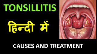 Tonsillitis  Infection of Tonsils  IN HINDI [upl. by Iren384]