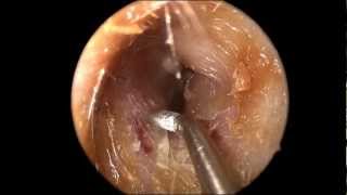 Ear Wax Cerumen Removal in HD [upl. by Brouwer795]