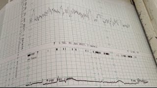 Maîtriser l’analyse du rythme cardiaque foetal [upl. by Goober]