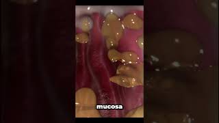 helicobacter pylori infection [upl. by Divd]