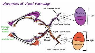 Visual Neural Pathways and Visual Field Defects [upl. by Sitruk848]