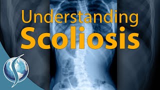 Understanding Scoliosis [upl. by Htesil478]