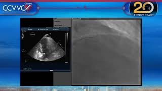 Live Case 14  Alcohol Septal Ablation under Echo Guidance  CCVVC 2017 [upl. by Irotal]