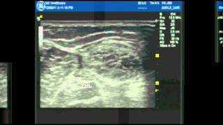 Ultrasound Guided ankle block part 1 [upl. by Anilev170]