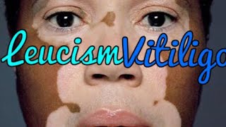 LEUCISM amp VITILIGO Evidence of Big DNA Changes in ALL FORMS OF LIFE On Earth QUANTUM Mandela Effect [upl. by Eirovi]