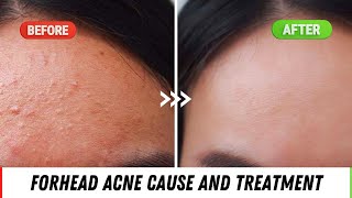 Forehead Acne Causes And Treatment  Quick Tips If You Have FOREHEAD ACNE  Dr Anvika [upl. by Innis]