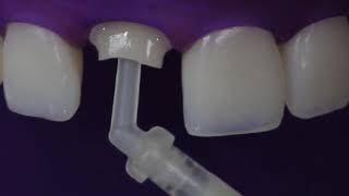 EN Fiberglass Posts and Core Buildups Cementation PROTOCOL [upl. by Lap]