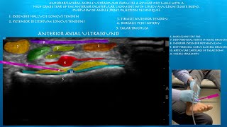 Ultrasound of High Grade ATFL Tear with Avulsion amp Anke Joint Injection Techniques [upl. by Forras]