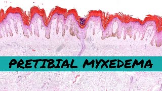 Pretibial Myxedema thyroid dermopathy of Graves disease hyperthyroidism [upl. by Bruno]