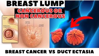 BREAST LUMP Cancerous VS Non  Cancerous  Duct Ectasia or Breast Cancer  Detailed Video [upl. by Irrot]