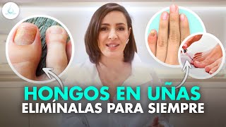 🔴 ¡Lo mejor para PREVENIR CURAR y ELIMINAR los HONGOS en las uñas PARA SIEMPRE drapilarochoa [upl. by Canute]