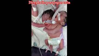 Neonatal Cases  Rare conjoined twins with two heads one body Dicephalic parapagus twin neonate [upl. by Schlessinger984]