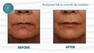 Restylane silk with cannula San Diego [upl. by Ehrenberg]