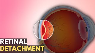 Retinal Detachment Everything You Need To Know [upl. by Solegna819]