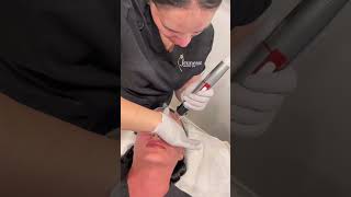 Genius Radiofrequency Microneedling [upl. by Glennon]