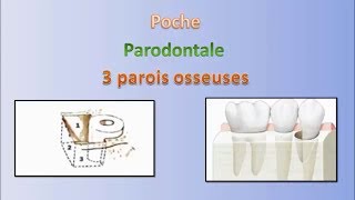 Les poches en parodontologie  Pocket in periodontology [upl. by Roybn]