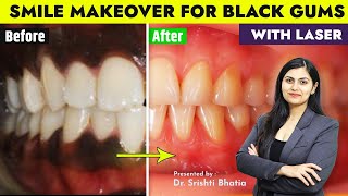 Smile Makeover for BLACK Gums with Dental LASER Dr Srishti Bhatia smiledesign smile [upl. by Buehler749]