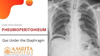 Case Discussion  Pneumoperitoneum  Gas Under the Diaphragm [upl. by Lavud]