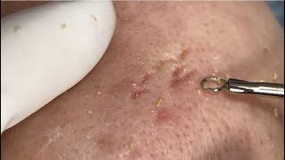 Blackheads Removal  LyLyBeautySpa [upl. by Rudman642]