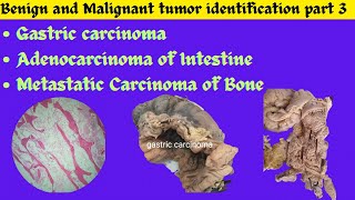 Gastric carcinoma Adenocarcinoma of Intestine Metastatic tumor of Bone identification Patho OSPE [upl. by Grannie]