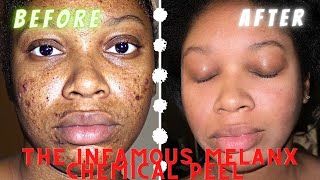 TRUTH ABOUT PORE STAR 850 CHEMICAL PEEL [upl. by Cutlip268]