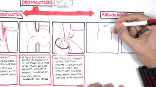 Bowel Obstruction  Causes and Pathophysiology [upl. by Rondon]