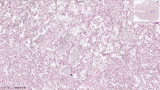 Pneumocystis Jirovecii Pneumonia  Histopathology [upl. by Rakabuba]