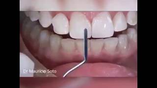 Composite Veneers step by step  All the Secrets [upl. by Yesteb971]