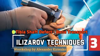 Ilizarov Techniques Worckshop  Part 3  Tibia Shaft Defect  Bone Transport by Alexander Kirienko [upl. by Adlihtam595]