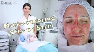 MICRONEEDLINGSKINNEEDLING Acne Scars Wrinkles Large PoresPigmentation Fine lines [upl. by Anairo601]