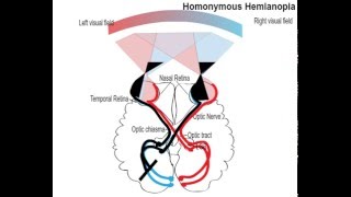 homonemous hemianopia [upl. by Kurland373]