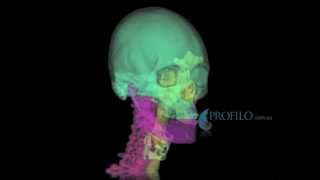 Airway assessment prior to maxillofacial jaw surgery [upl. by Alithea]