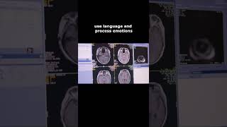 What vision changes can a brain tumor in temporal lobe [upl. by Han]