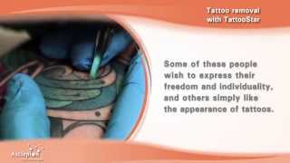 Tattoo removal with the TattooStar qswitched laser by Asclepion [upl. by Hartzel]