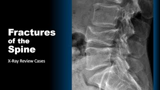 Fractures of the Spine XRay Cases radiology spine trauma doctor [upl. by Auqenes]