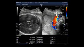 Ultrasound Video showing Bilateral Fetal enlarged kidneys with Renal Parenchymal disease [upl. by Nil]