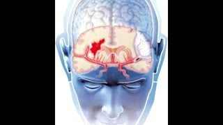 Tratamiento de aneurismas cerebrales ACV [upl. by Dwan]